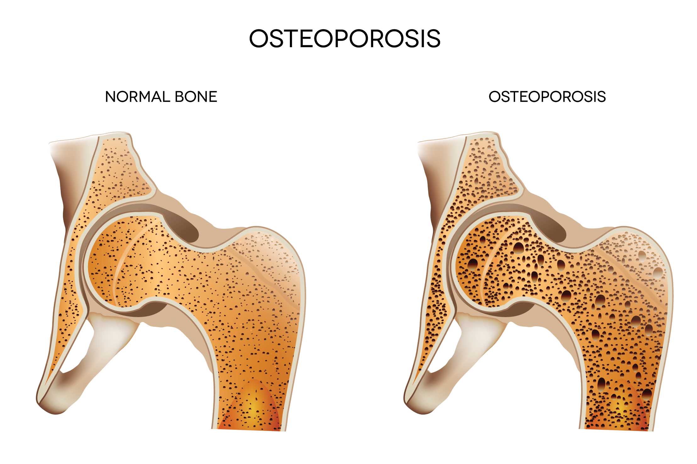 O que é osteoporose?