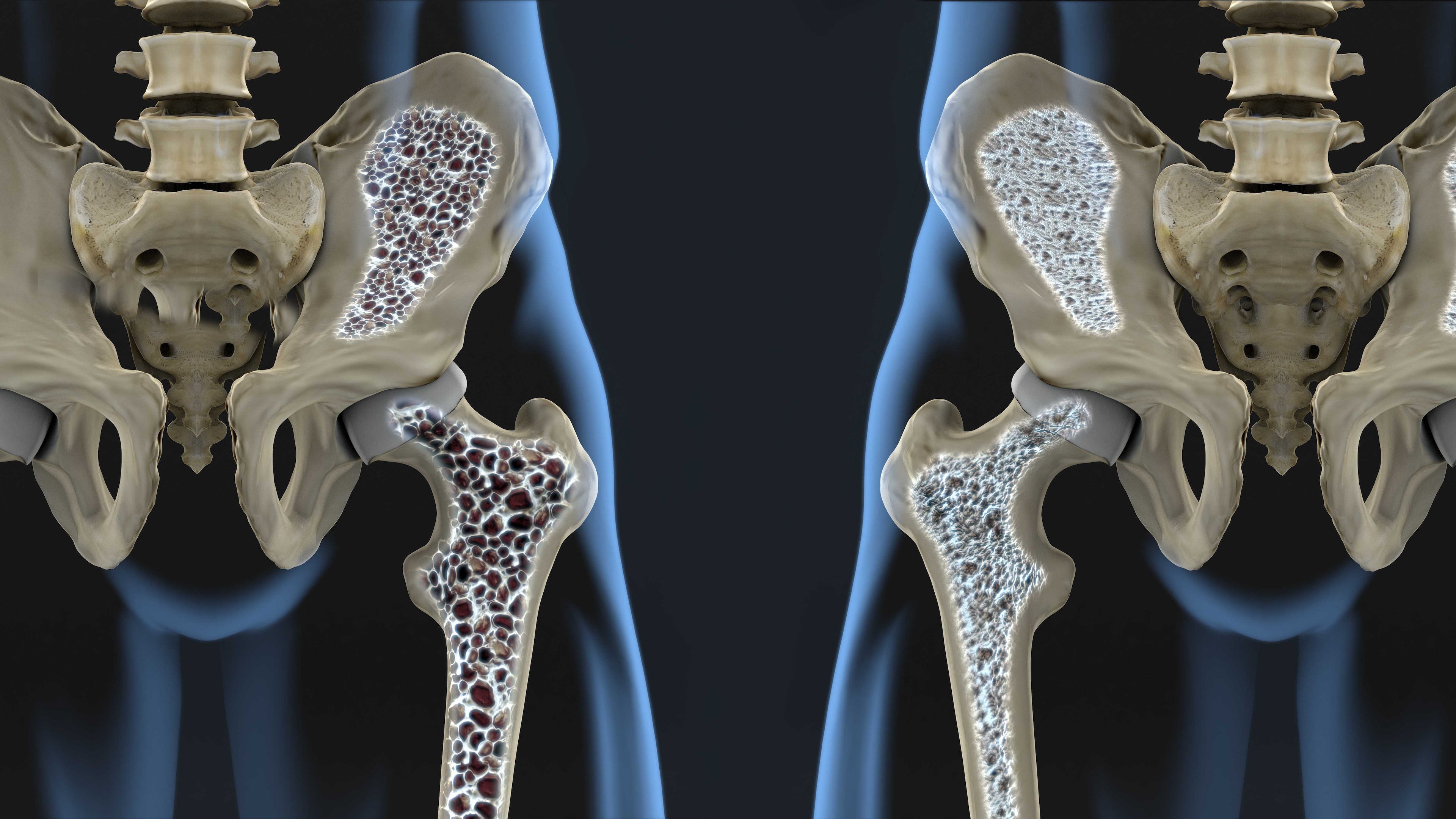Diagnósticos Osteoporose